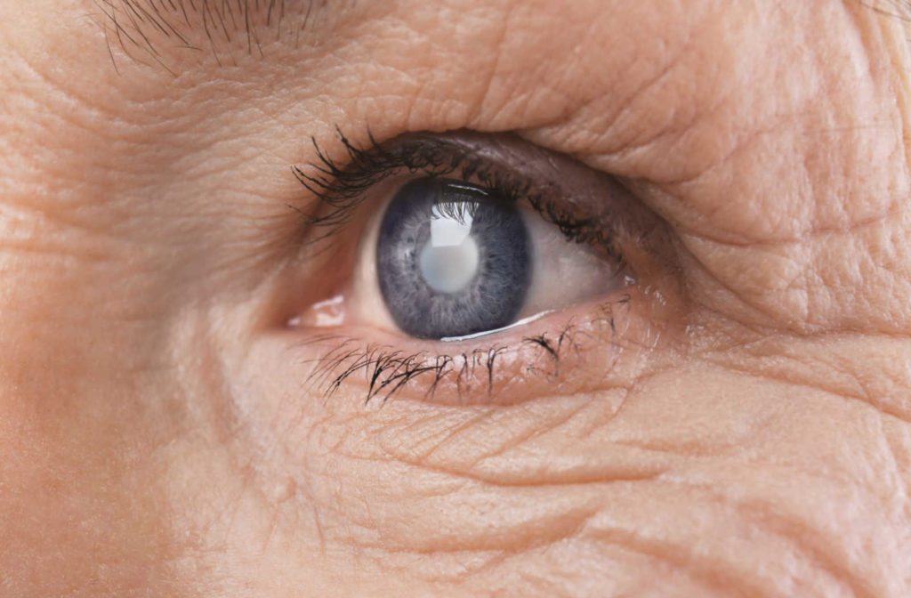 A close up of an aging eye with cataracts.